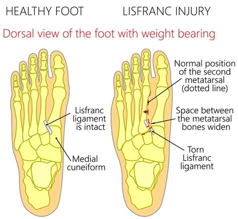 Dorsal Foot Pain [Causes, Symptoms & Best Treatment]