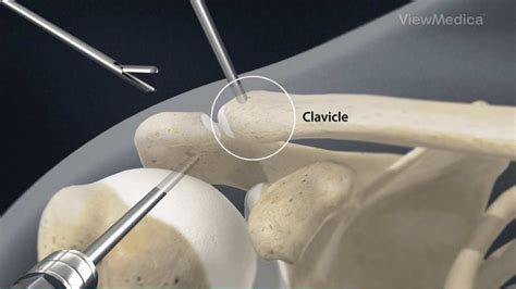 Distal Clavicle Excision - Distal Clavicle Excision surgery photos