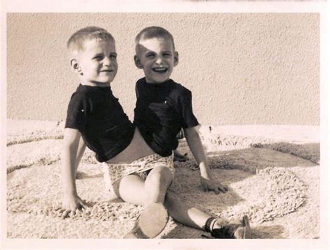 Ronnie and Donnie Galyon (American conjoined Twins) ~ Bio Wiki | Photos ...