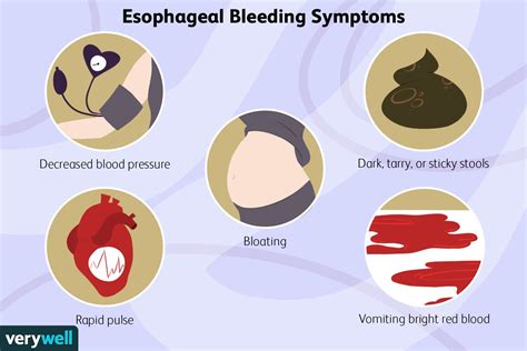 Causes de saignement des varices œsophagiennes - Fmedic