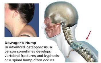 dowagers hump - neck pain - DOCJOINTS//DR SUJIT JOS//Total joint ...