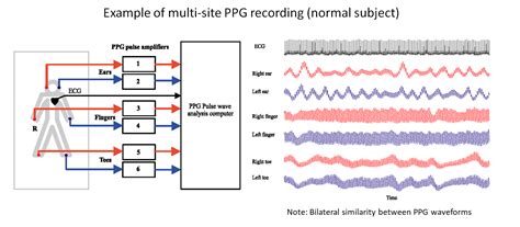 Photoplethysmography (PPG): State-of-the-art methods and applications - Physiological ...