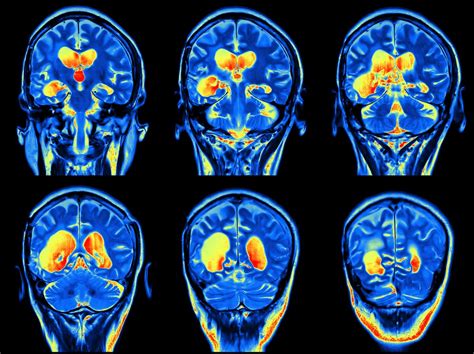 Être bilingue réduit l’impact d’Alzheimer sur le cerveau