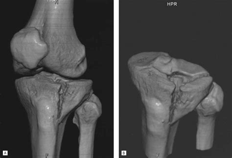 Orthopedic trauma | Musculoskeletal Key