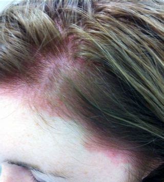 Woman Has Horrible Allergic Reaction to Salon Hair Dye Job - PPD Allergy Photos