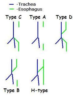 Tracheoesophageal fistula - wikidoc