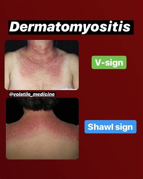 dermatomyositis rash