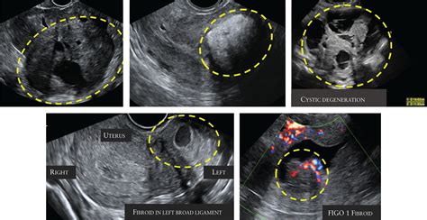 Intramural Fibroid Ultrasound