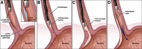 How to Perform a High-Quality PerOral Endoscopic Myotomy? - Gastroenterology