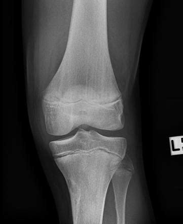 Tibial spine fracture with anterior cruciate ligament avulsion - type 4 ...