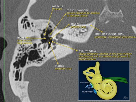 The Radiology Assistant : Temporal bone - Anatomy 2.0 | Radiology, Radiology imaging, Medical ...