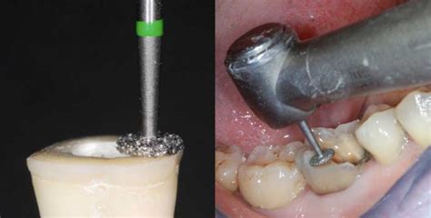 The Endocrown: A Different Type of All-Ceramic Reconstruction for ...