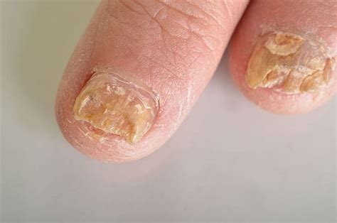 What Is A Toenail Fungal Infection? - Walkrite Foot Clinic
