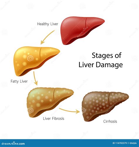 Stadien Des Leberschadens Lebererkrankung Vektor Abbildung ...