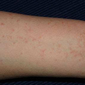 Scabies Bites: Pictures, Symptoms, and Treatments