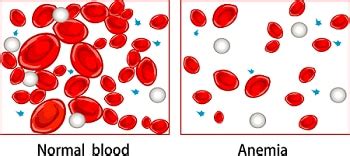 Anemia of Inflammation or Chronic Disease - NIDDK