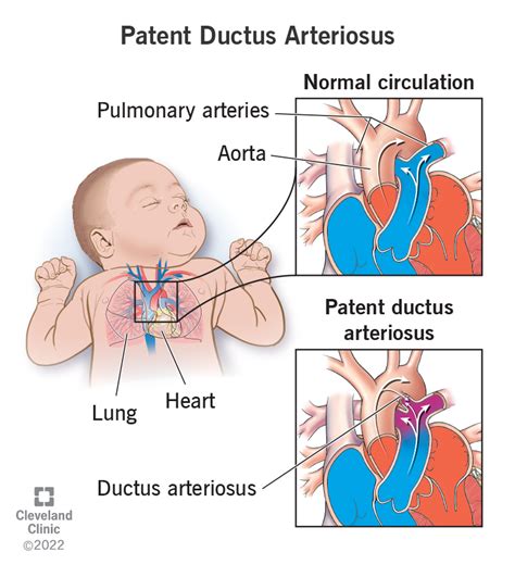 Patent Ductus Arteriosus (PDA): Symptoms and Treatment