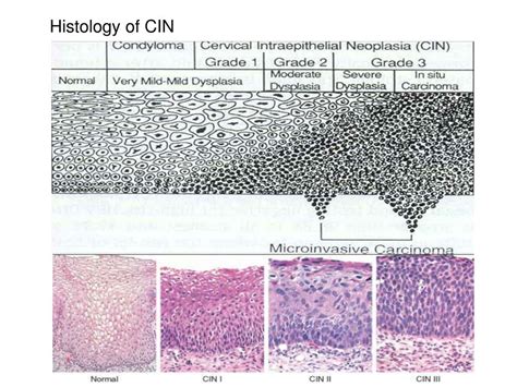 Cervical Cancer Histology