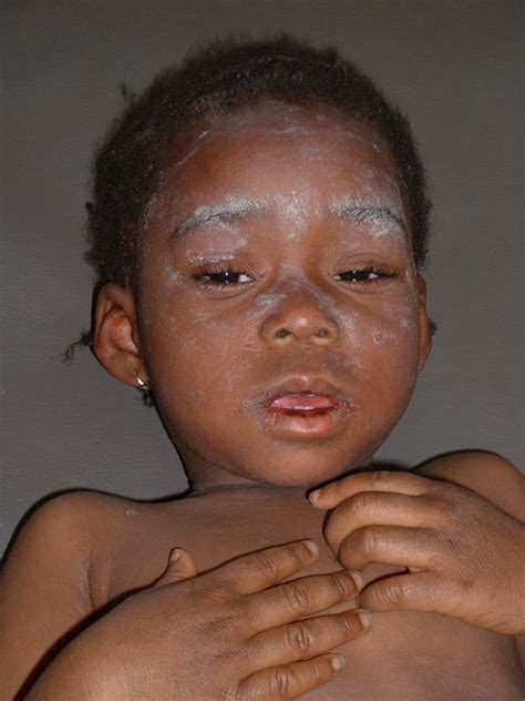 Kaduna State Primary Health Care Agency to Commence Measles Vaccination ……….State government ...