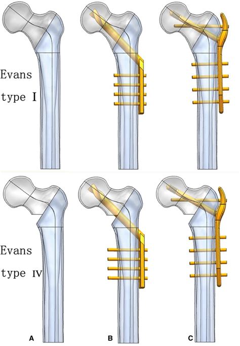 Frontiers | A comparative Study of Novel Extramedullary Fixation and Dynamic Hip Screw in the ...