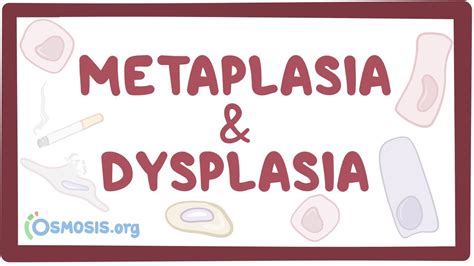 Metaplasia and dysplasia: Video, Causes, & Meaning | Osmosis