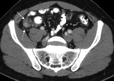 The Appendix | Radiology Key