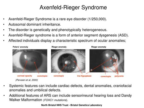 PPT - Axenfeld-Rieger Syndrome: A New UKGTN Service PowerPoint ...