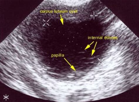 Corpus Luteum Cyst Corpus Luteum Cysts Ultrasound | SexiezPicz Web Porn