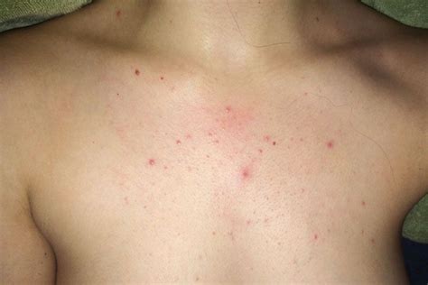 Chest Acne : Causes, Treatment and Prevention