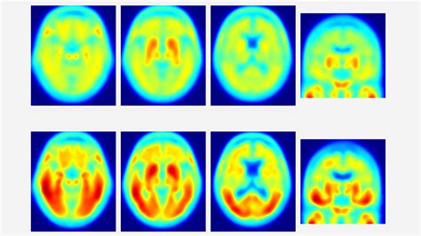 Tau protein—not amyloid—may be key driver of Alzheimer's symptoms ...