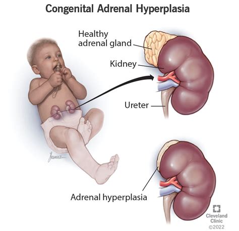 Congenital Adrenal Hyperplasia Adults