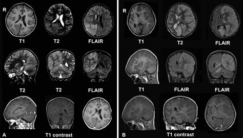 File:MRI Rasmussen's encephalitis.png - Wikimedia Commons