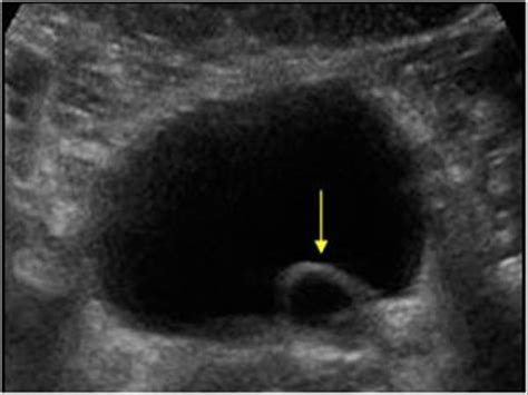 Urinary Tract and male reproductive system | 2.2 Bladder : Case 2.2.3 Miscellaneous bladder and ...