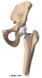 Ceramic Hip Replacement,Cost Ceramic Hip Replacement Surgery in India