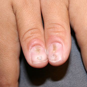 magical beauty: Nails abnormalities & their causes!