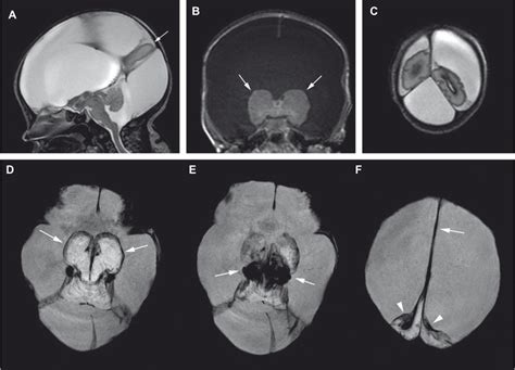 Hydranencephaly Mri