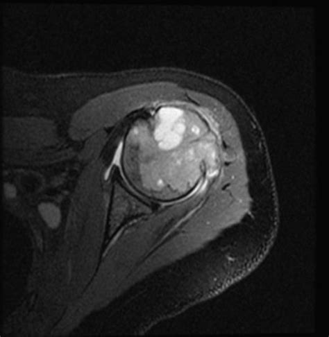 Case of the Month: Humeral Mass - University of Rochester Medical Center