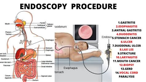 Upper endoscopy findings gi bleed - roofkool