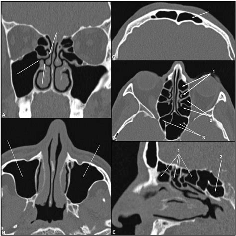 (A–E) Coronal, axial and sagittal CT images of the bone window... | Download Scientific Diagram