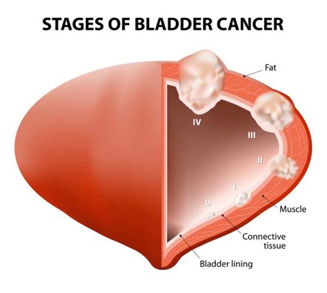 Bladder Cancer - North Georgia Urology Center