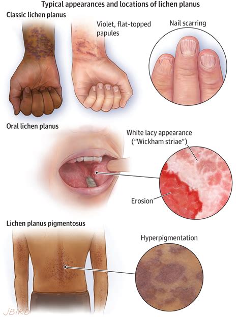 Lichen Planus. | Dermatology | JAMA Dermatology | JAMA Network