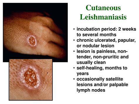 PPT - Leishmaniasis PowerPoint Presentation, free download - ID:4403063