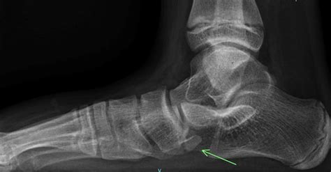 Clinical Practice Guidelines : Navicular Fractures - Emergency Department