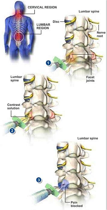 Facet Joint Injections - The Southeastern Spine Institute