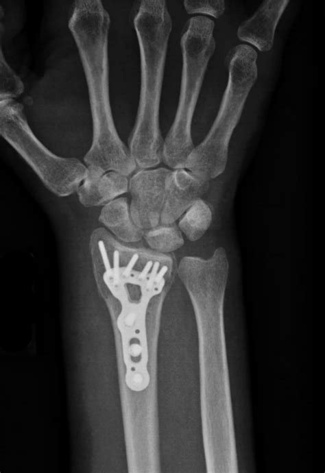 Fractures Of The Right Distal Radius And Ulna With Fixation | My XXX Hot Girl