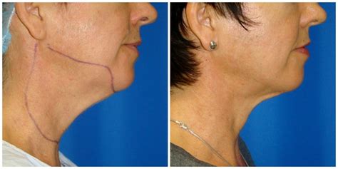 Chin Liposuction / Houston Lipo Center