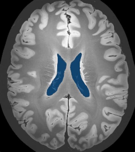 Lateral Ventricles (50 MRI cases) - MedSeg