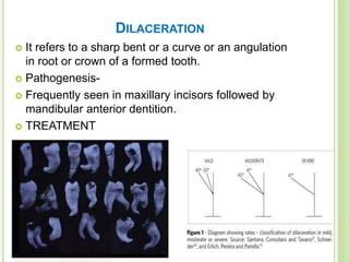 Developmental Disturbances in Shape of Tooth | PPT