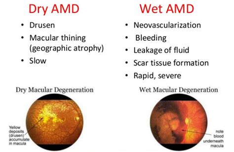 Macular Degeneration | AMD | Causes and Treatment | EyeMantra