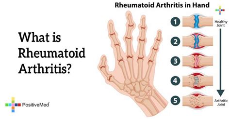 What is Rheumatoid Arthritis? - PositiveMed